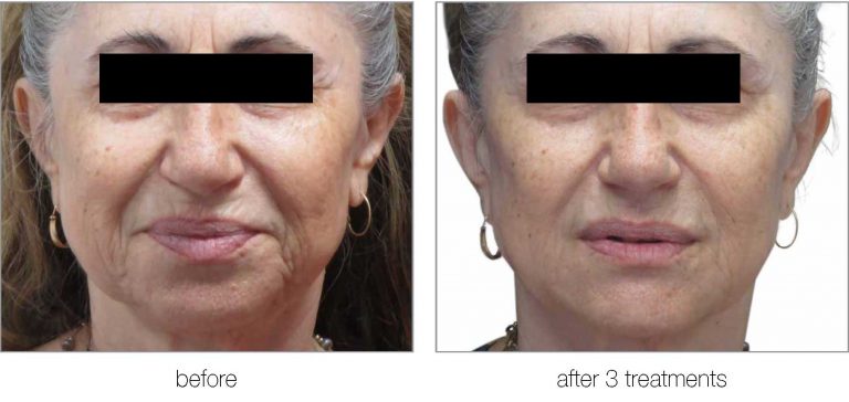 Before and after image after treatment in giovanni med spa