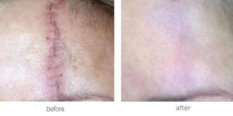 Before and after image of the venus legacy treatment