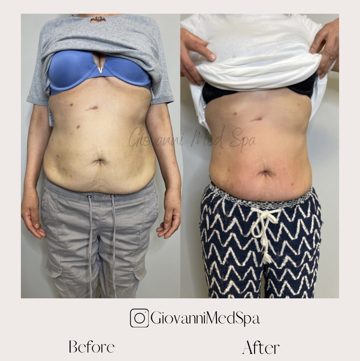 Eves Body Organic MedSpa - Before and After Bra line Lipo